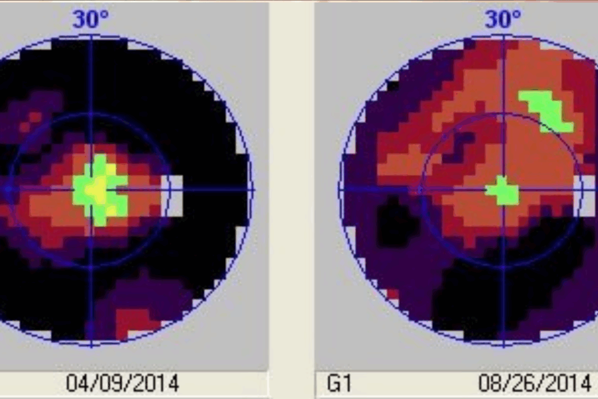 retinitis pigmentosa